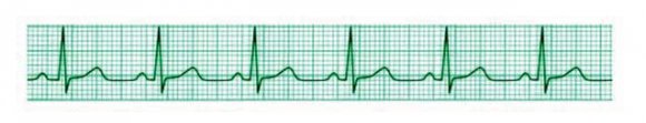 Figure 3 : Einthoven's triangle and the axes of the six ECG leads formed by using four limb leads [3] III.