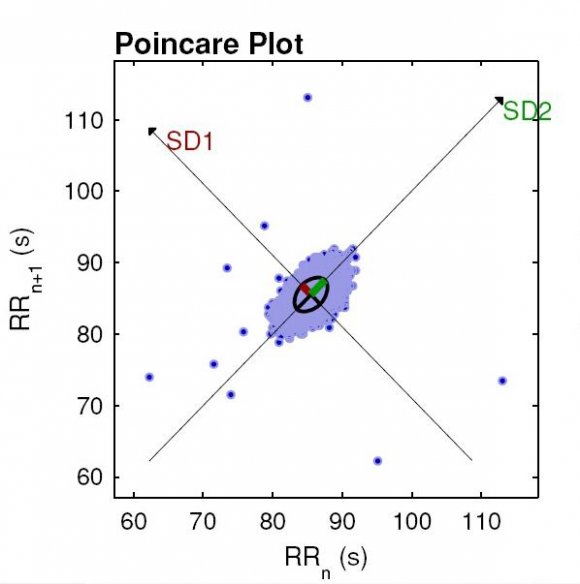 Figure 3.9 : SDSD for normal & abnormal patient