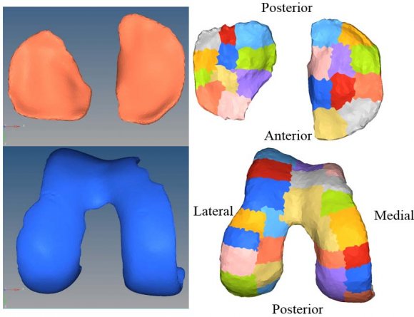 Fig.2a. If different sections of cartilages are assigned with different material properties, it is called heterogeneous model which is shown on the right part of Fig.2a. For heterogeneous cartilage, 21 regions are used for tibial cartilage and 29 regions are assigned with different materials for femoral cartilage. Homogeneous cartilage and heterogeneous cartilage are assembled with other knee components in Abaqus, shown in Fig 2b.