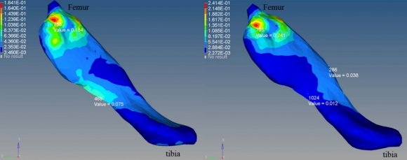 Figure 4a: S Shear strain in ACL upon 3g loading at 30 (left) and 45 (right) flexion anglestensile strain in 30 degree, 11.9%, is comparable with that in 45 degree, 10.9%. At the centre part of ACL, tensile strain is 7.2% for 30 degree and 2.4% for 45 degree knee flexion angle.